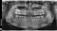 air techiques scanx Dental  CR Radiology 15x30 cm picture